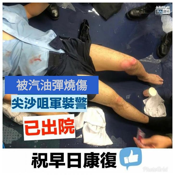 【早日康復】尖沙咀被汽油彈燒傷警員已出院