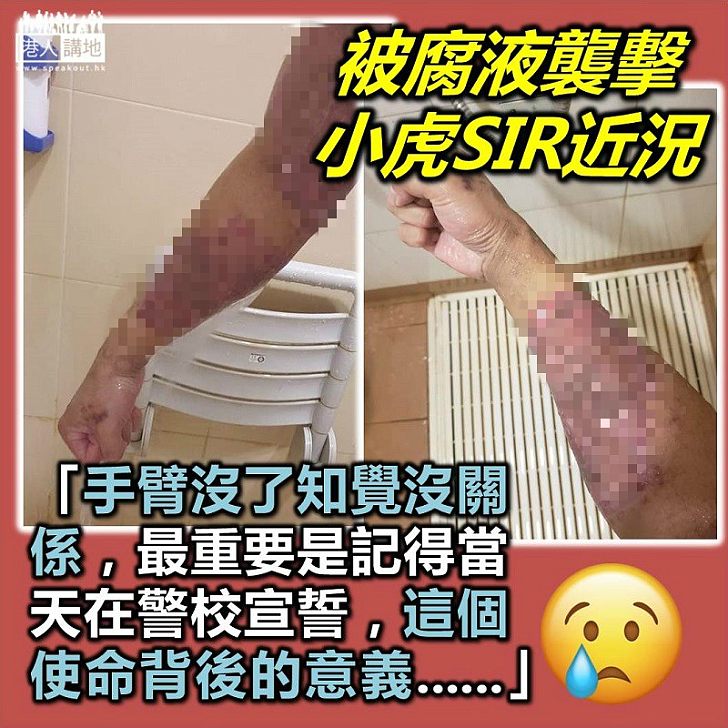 【忠誠勇毅】被腐蝕性液體襲擊小虎SIR：手臂沒了知覺沒關係，最重要記得在警校宣誓的使命和意義