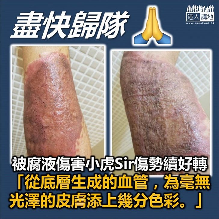 【盡快康復】被腐蝕性液體傷害小虎SIR傷勢續好轉