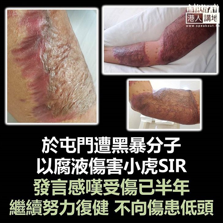 【小虎加油】小虎SIR再次發文 直言繼續努力復健、不會向傷患低頭