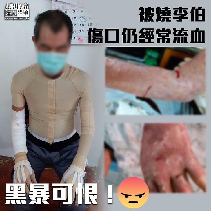 【喪心病狂】被燒李伯傷口仍經常流血:全身傷口都痕到甩骨