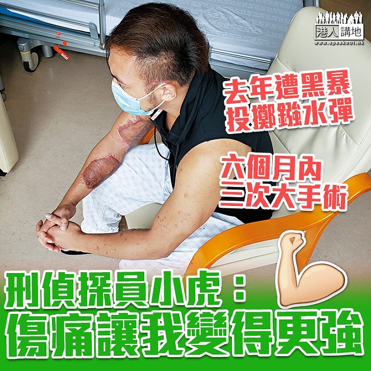 【黑暴運動】去年國慶日遭黑暴投擲鏹水彈 刑偵探員小虎:傷痛讓我變得更強