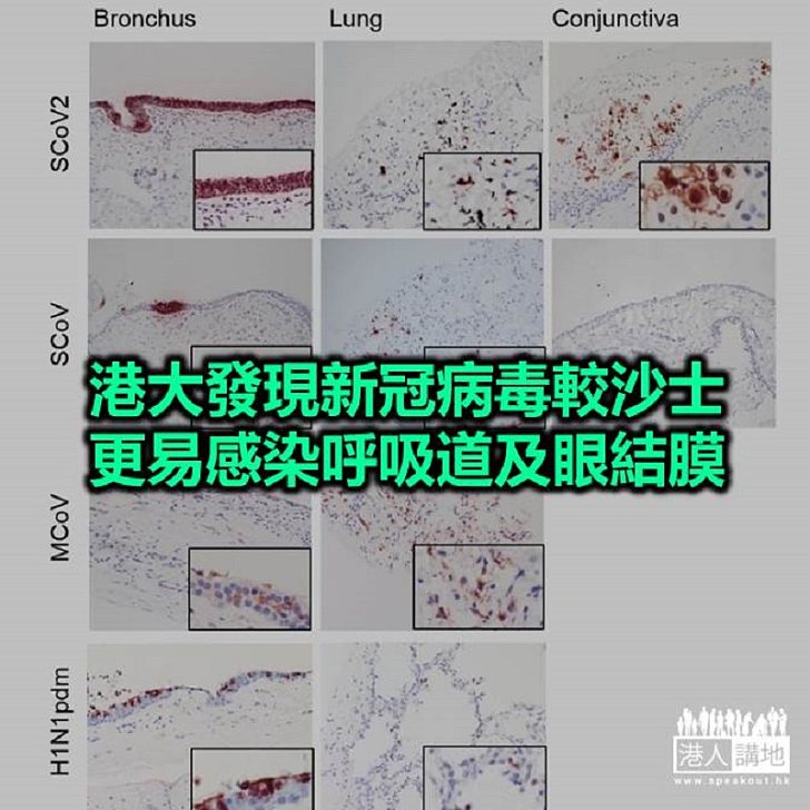 【焦點新聞】港大研究指眼睛或為感染新冠病毒重要途徑